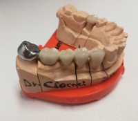 Lucrare metalo-ceramica  Lucrare metalo-ceramica