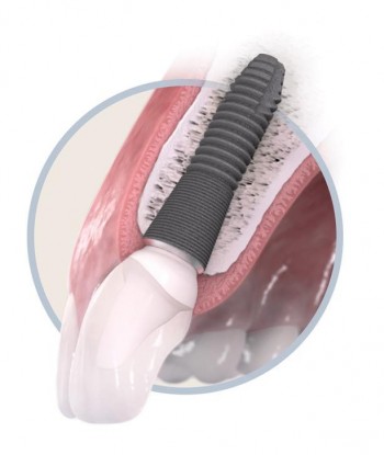 Avantajele implantului dentar
