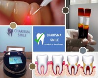 Tratament Laser Boala Parodontala Tratament Laser Boala Parodontala
