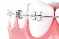 Aparat dentare fixe si mobile Aparat dentare fixe si mobile